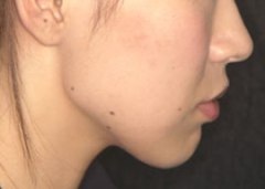 症例1 顔貌 治療後 症例1 顔貌 治療後