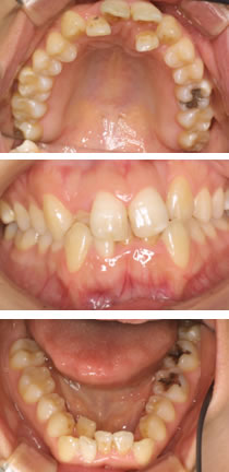 症例2 歯列 治療前 症例2 歯列 治療前