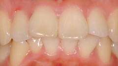 審美歯科症例１治療前