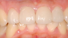 審美歯科症例１治療後