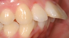 審美歯科症例２治療前