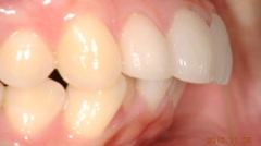 審美歯科症例２治療後