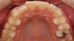審美歯科症例３治療前