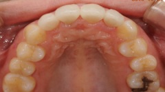 審美歯科症例３治療後